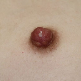 両側からきれいな乳汁分泌