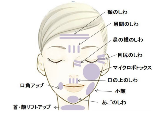 額・眉間・鼻・目尻など打つ部位イメージ