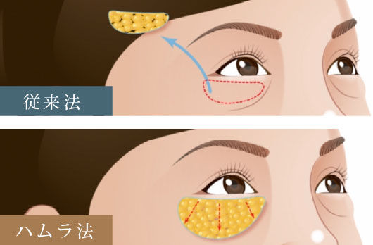 従来法とハムラ法の比較イラスト