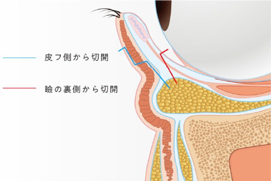 皮膚側から切開、瞼の裏側から切開のイラスト