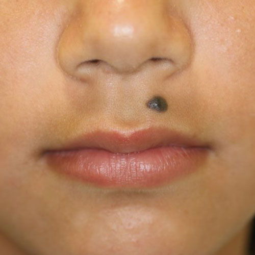 ほくろ　写真・画像