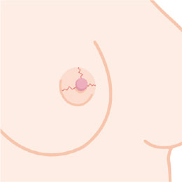 疾患のイラスト