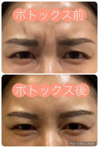 表情ジワにはボトックス！深く刻まれてしまうその前に！！