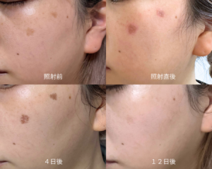 長年の悩みとおさらば？！シミ取りレーザーレポ📝💥
