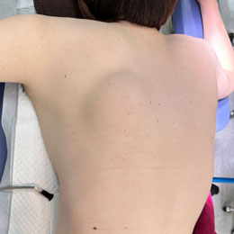 背中にできた脂肪腫