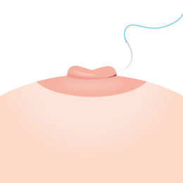 乳首の凹みを治療するイメージ