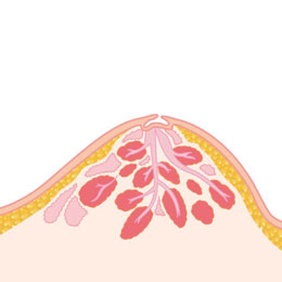 陥没乳頭イメージ