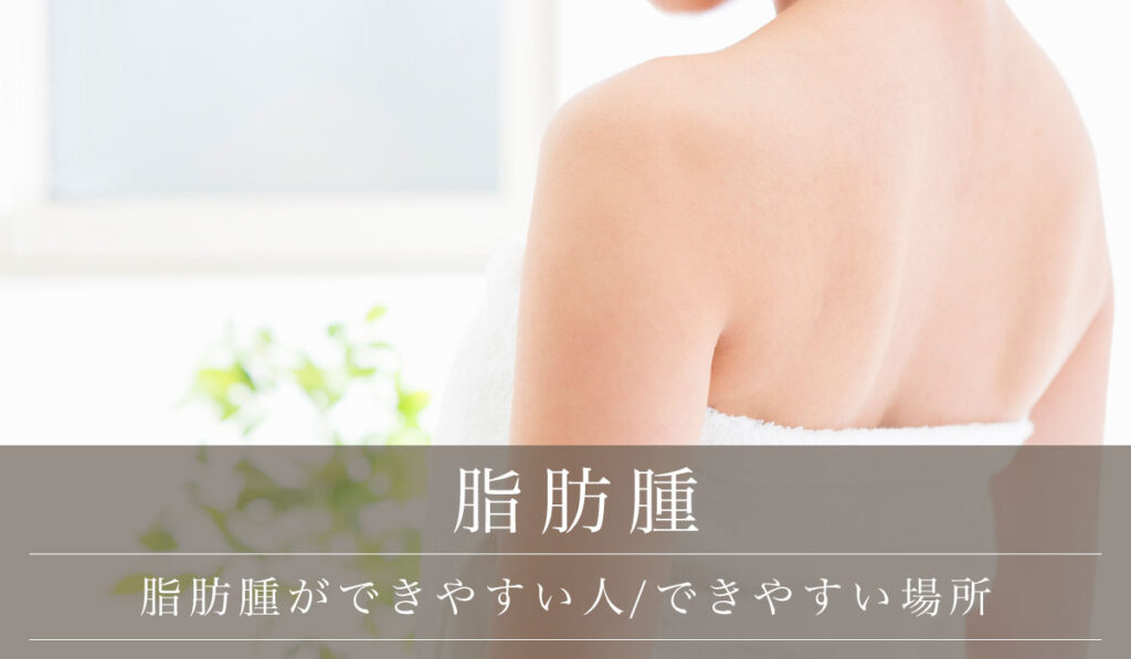 【脂肪腫ができやすい人/できやすい場所】原因と予防・食事についても解説
