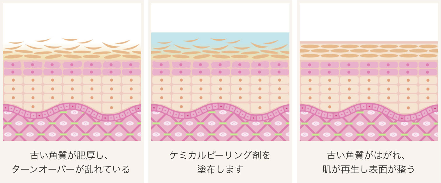 ケミカルピーリングの塗布イメージ