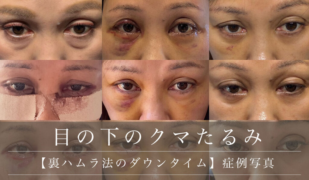 【裏ハムラ法のダウンタイム】手術直後から30日の経過/軽度（短い）・中等度・重度（長い）症例写真