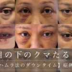 【裏ハムラ法のダウンタイム】症例写真