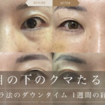 【裏ハムラ法のダウンタイム 1週間の経過写真】