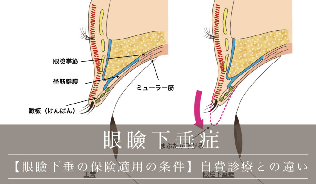 【眼瞼下垂の保険適用の条件】自費診療との違い/美容外科によりデザインも配慮