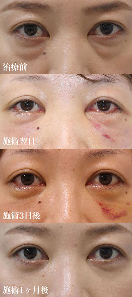 中等度の治療前・翌日・3日後・1ヶ月後