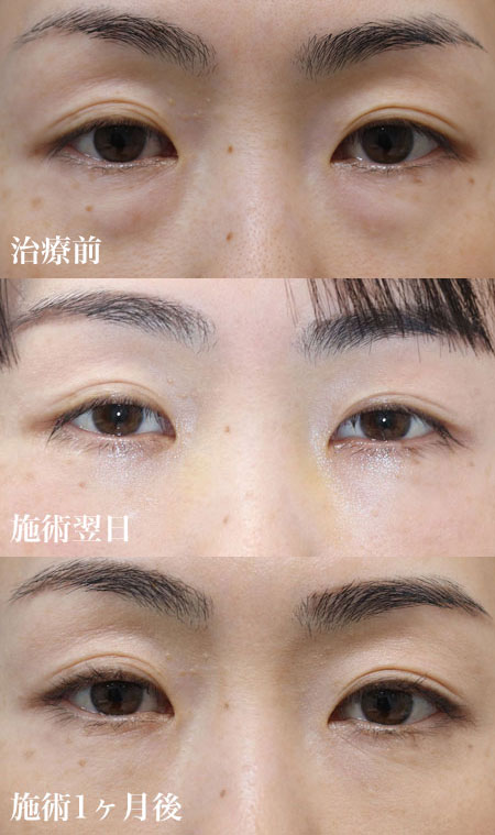 軽度の治療前・翌日・1ヶ月後