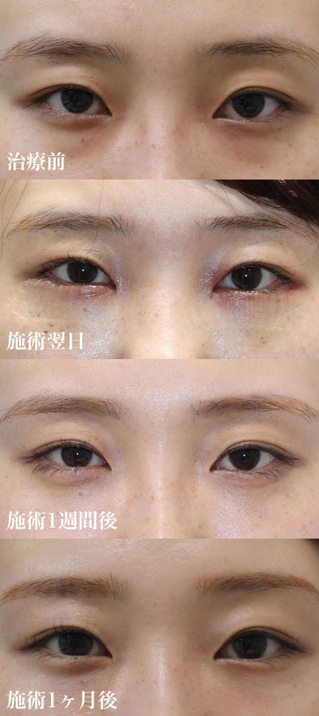 軽度の治療前・翌日・1週間後・1ヶ月後