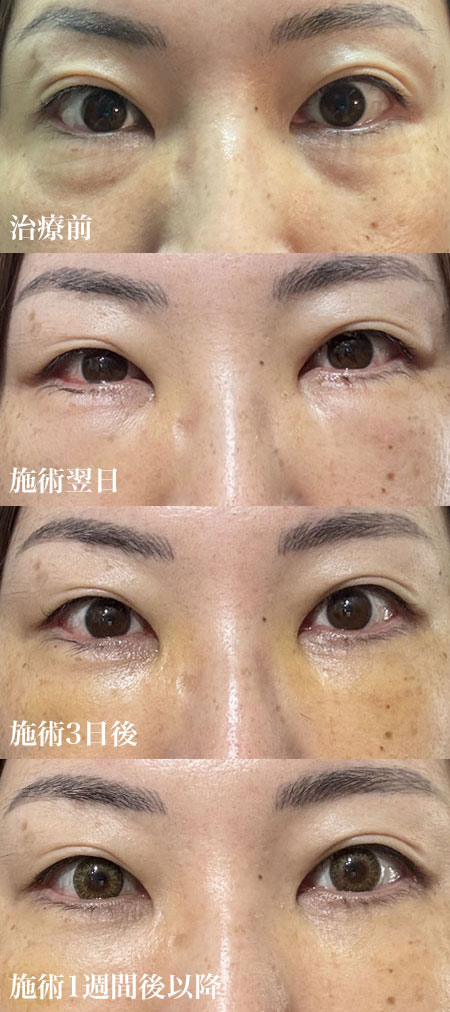 軽度の治療前・翌日・3日後・1週間後