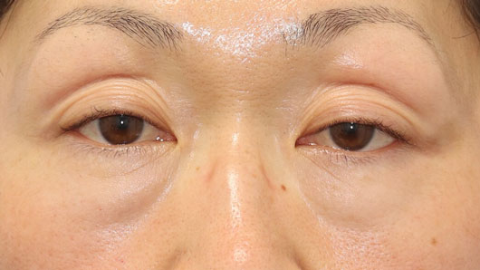 眼瞼下垂の女性