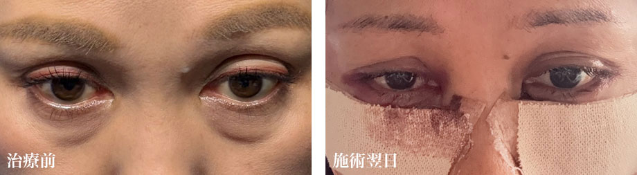 重度の手術前・手術直後テープ