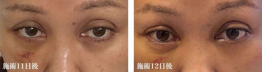 重度の11日目・12日目