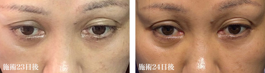 重度の23日目・24日目