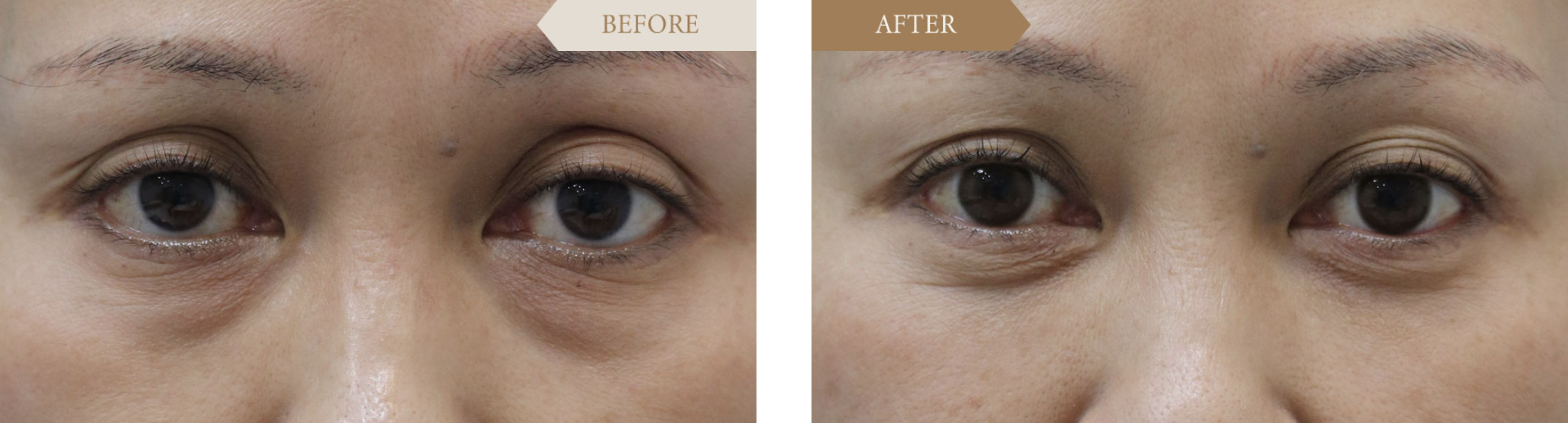 くぼみ目改善事例ビフォアアフター1