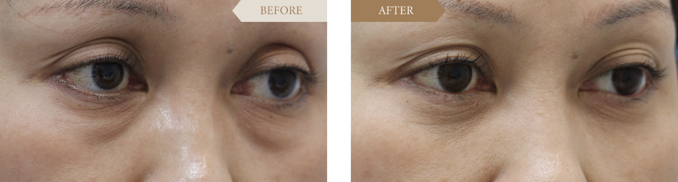 くぼみ目改善事例ビフォアアフター2