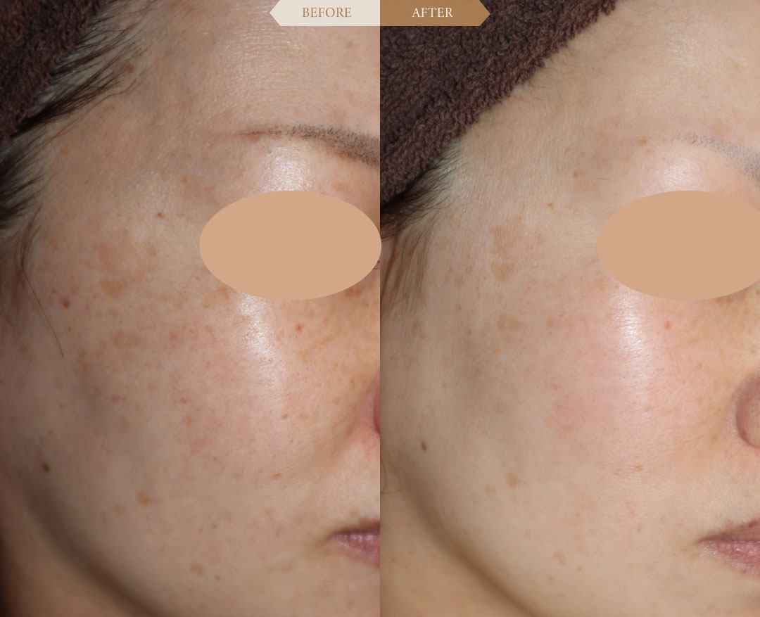 ピーリングとフォトフェイシャル治療