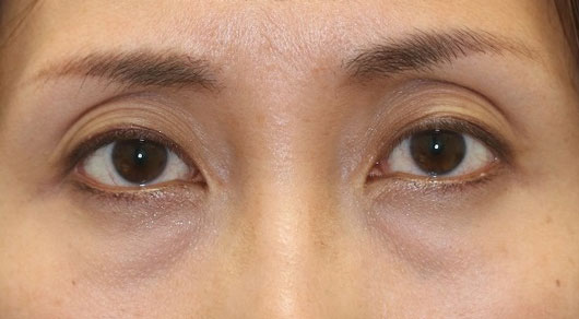 くぼみ目女性のビフォアー