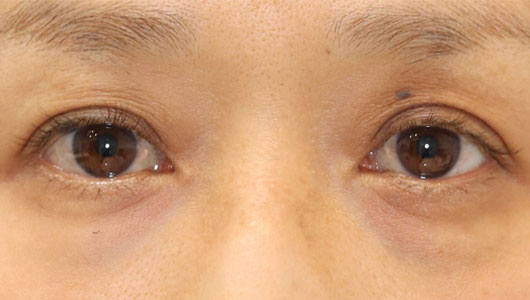 くぼみ目女性のビフォアー