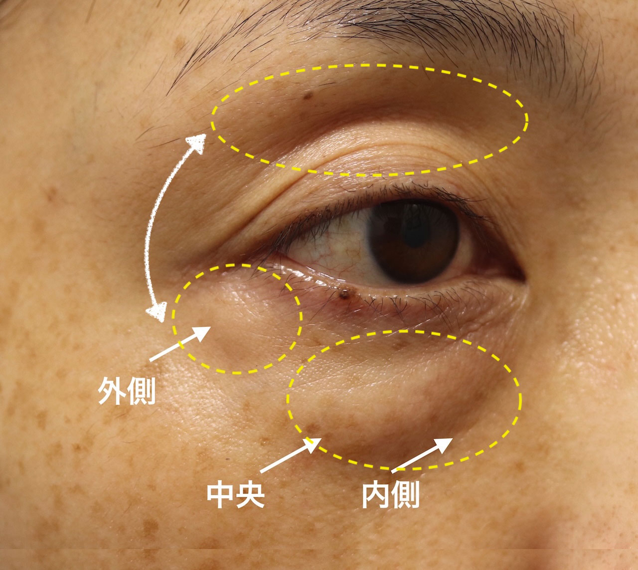 眼窩脂肪の偏在の解説