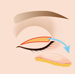 上まぶたの皮膚切除のイラスト