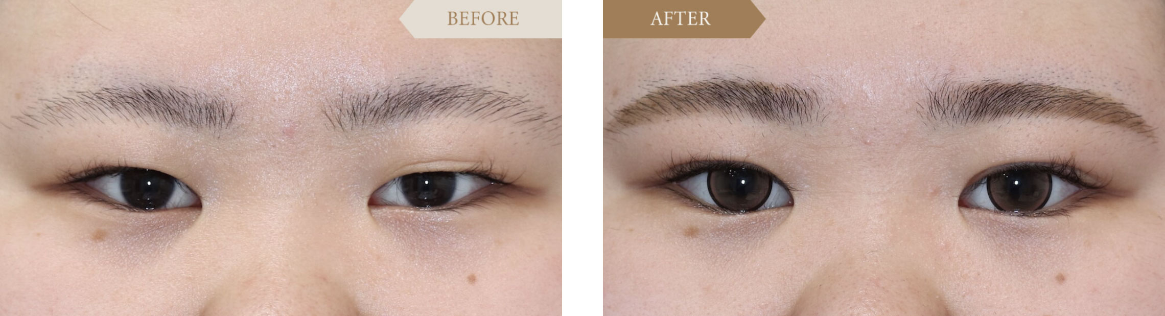 重い一重を二重に改善ビフォアアフター1