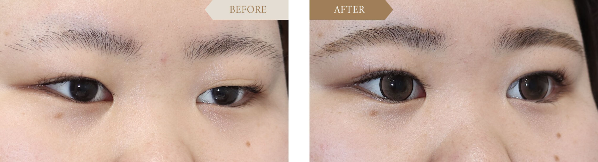 重い一重を二重に改善ビフォアアフター2