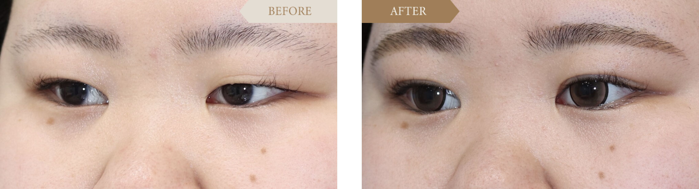 重い一重を二重に改善ビフォアアフター3