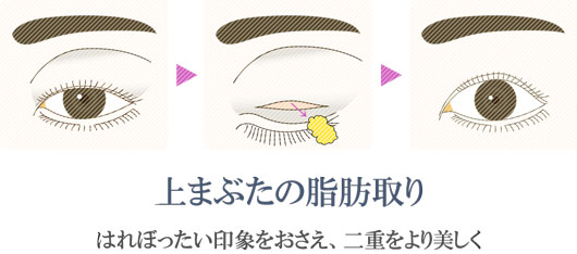 上まぶたの脂肪取り