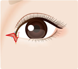 目頭切開法イラスト