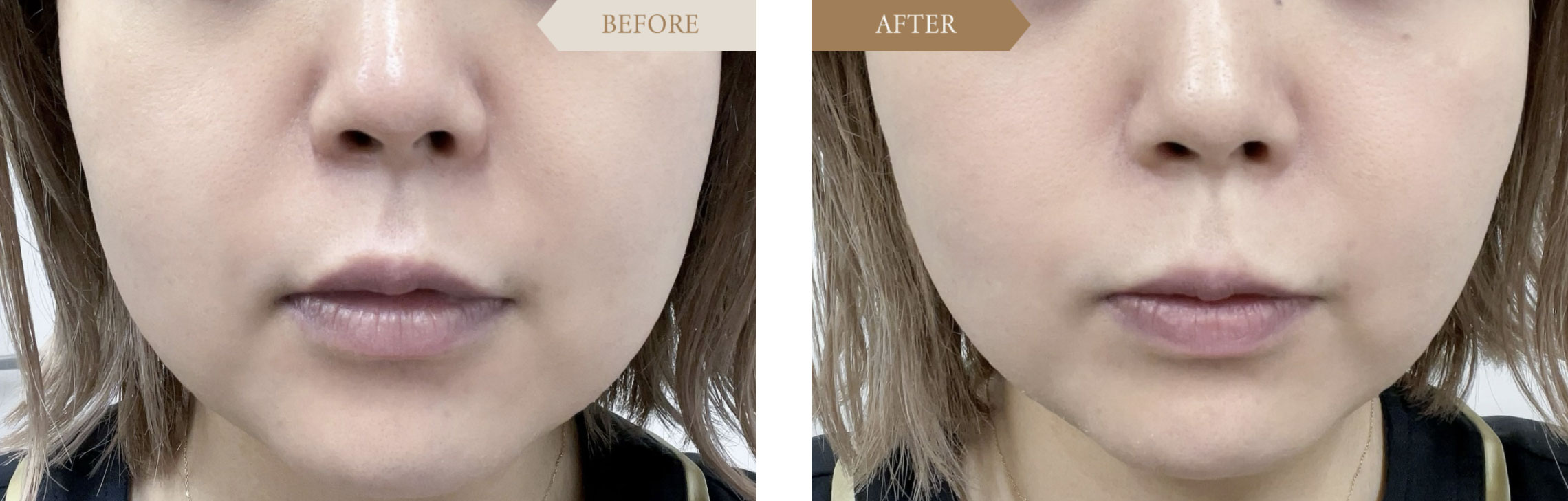 ハイフの施術事例ビフォアアフター