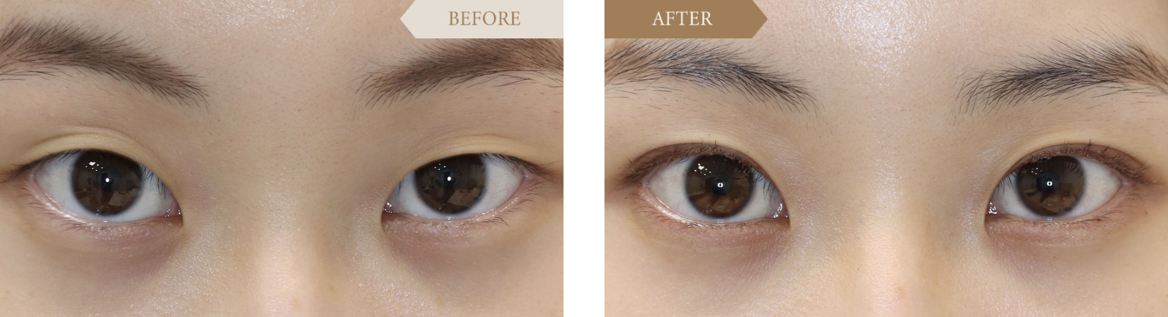 10代／女性 二重埋没法ビフォアアフター1