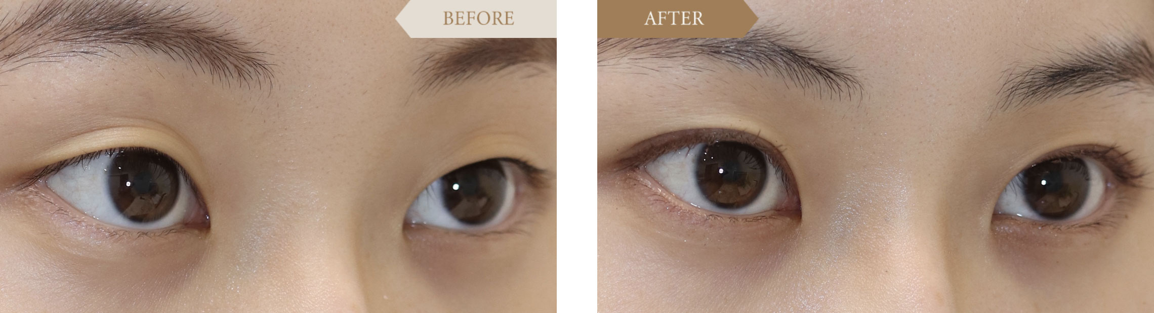 10代／女性 二重埋没法ビフォアアフター2