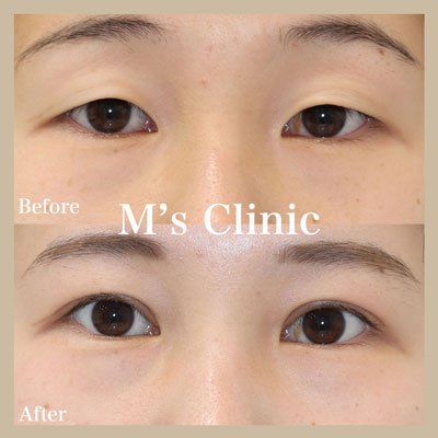 二重になった事例ビフォアアフター