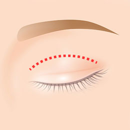 二重全切開法のイラスト