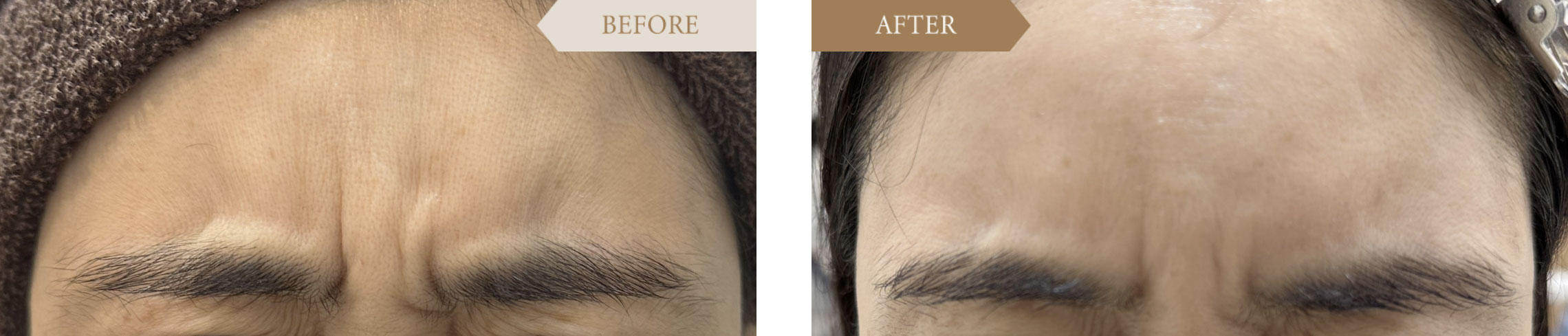 ボトックス眉間の症例ビフォアアフター