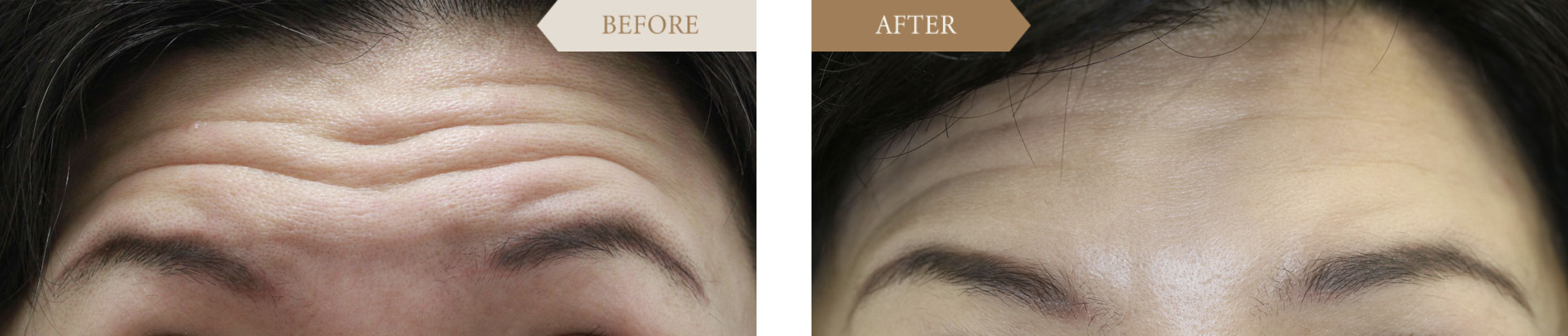 ボトックス額の症例ビフォアアフター