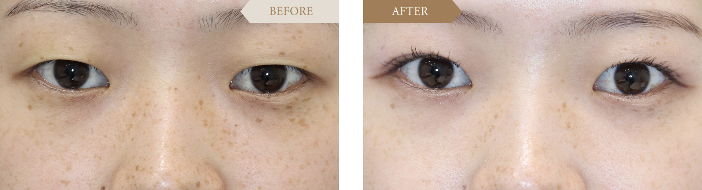 二重埋没法ビフォアアフター1