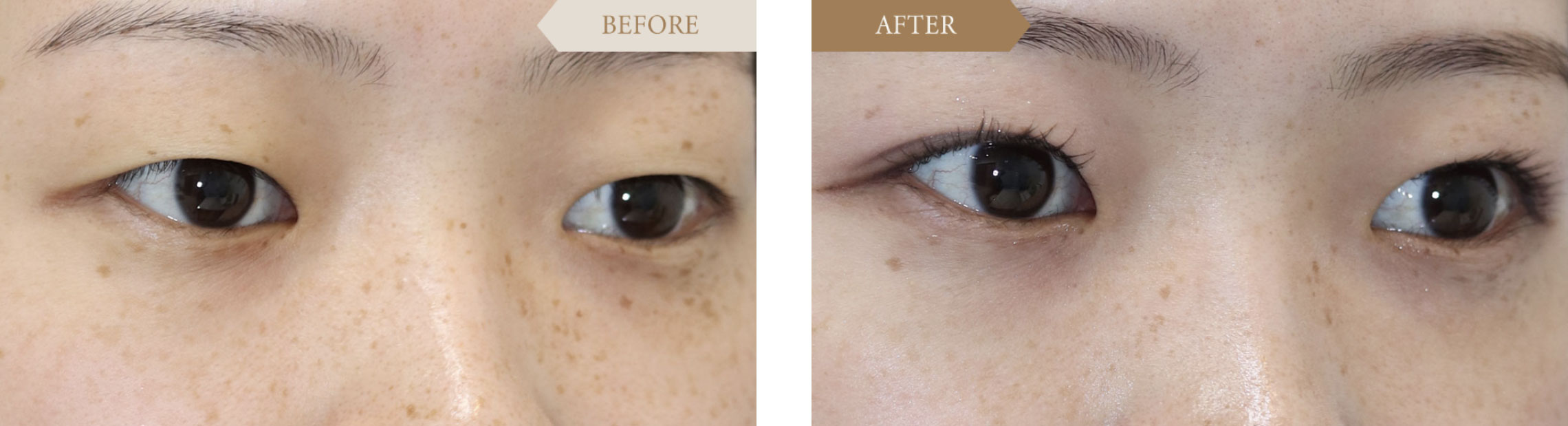 二重埋没法ビフォアアフター2