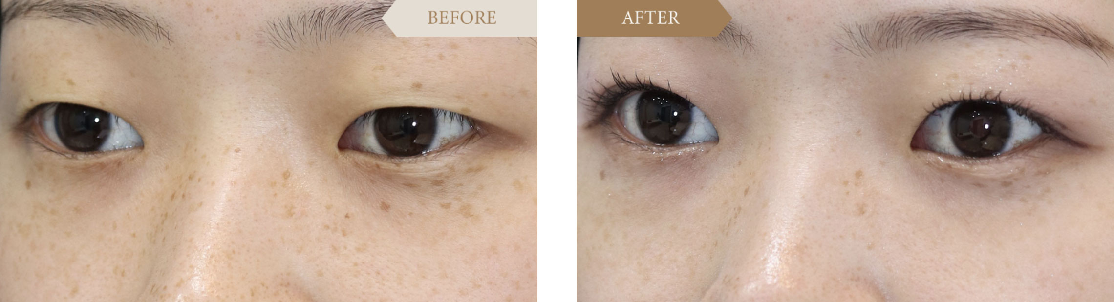 二重埋没法ビフォアアフター3