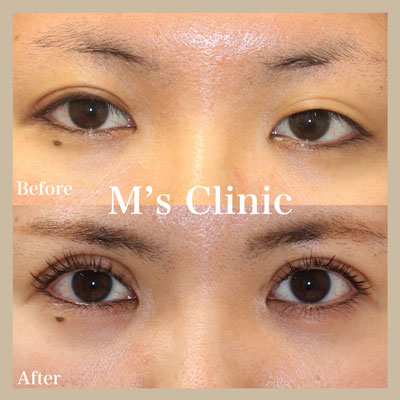 二重ビフォアアフター