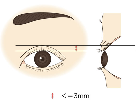二重幅3mmのイラスト