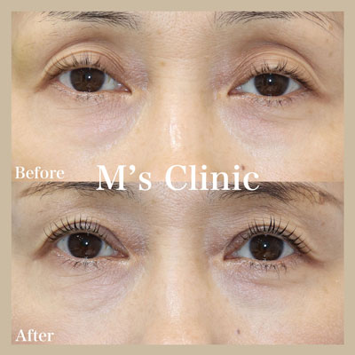 軽度の眼瞼下垂ビフォアアフター